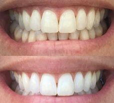 5 for $60 Whitening Toothpaste Deal